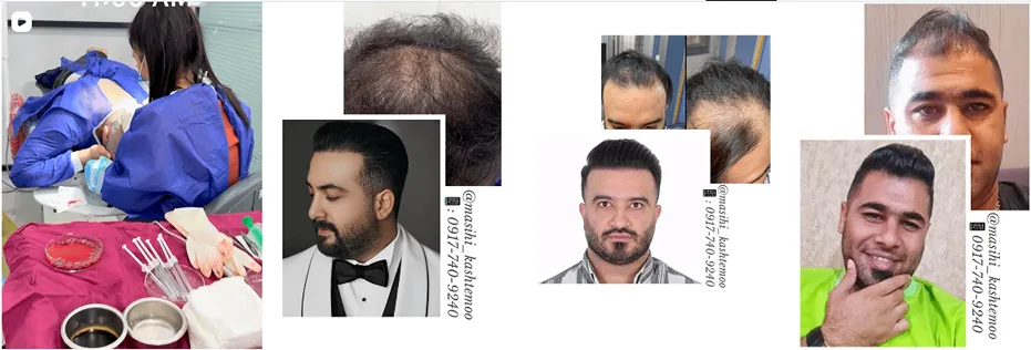 نمونه کار یکی از بهترین کلینیک کاشت مو بندرعباس را مشاهده میفرمایید.