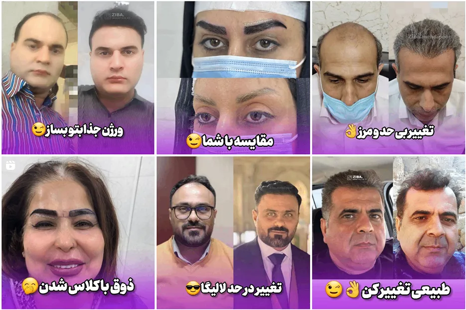 دکتر مهدی پور یکی از بهترین دکتر کاشت مو در اهواز است