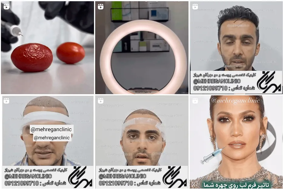 تصویر یکی از دکتر کاشت مو در شیراز را مشاهده میفرمایید.