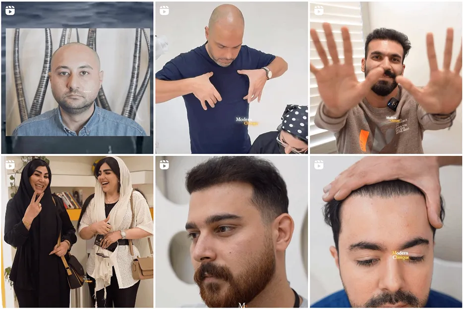 کلینیک مدرن کلینیک از بهترین کلینیک کاشت مو در تهران است