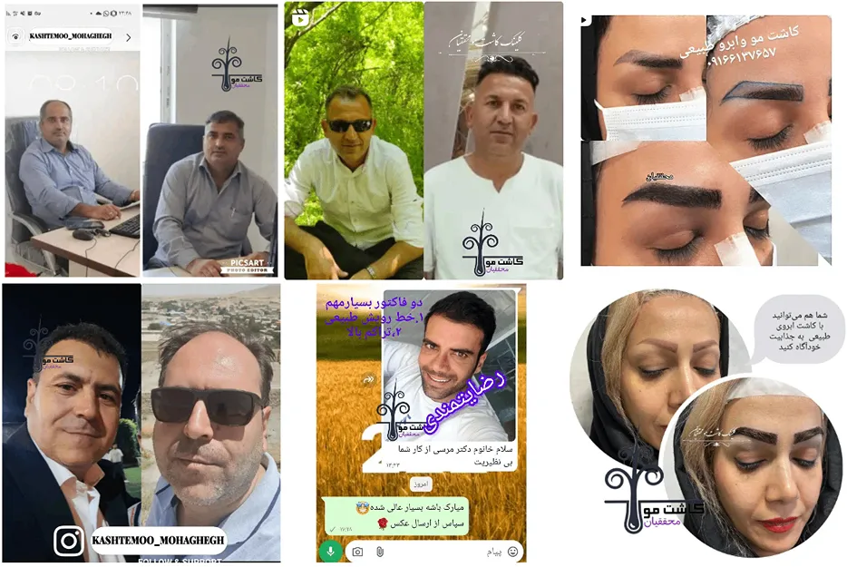 کاشت مو محققیان یکی از بهترین کلینیک کاشت مو در اهواز است