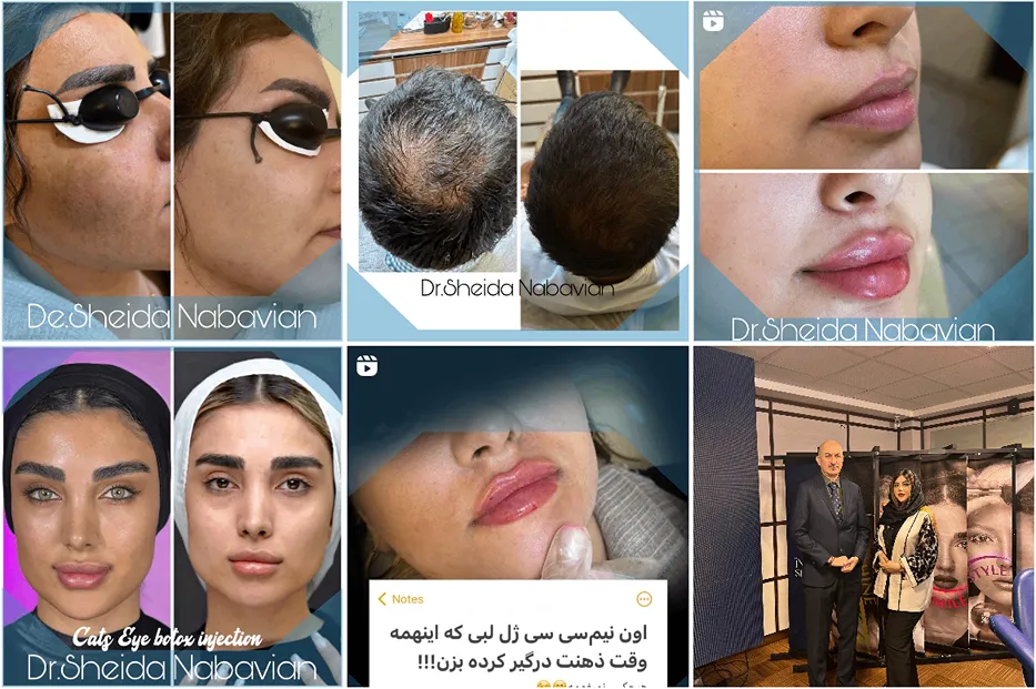 نمونه کار یکی از بهرتین دکتر کاشت مو در سمنان را مشاهده میفرمایید.