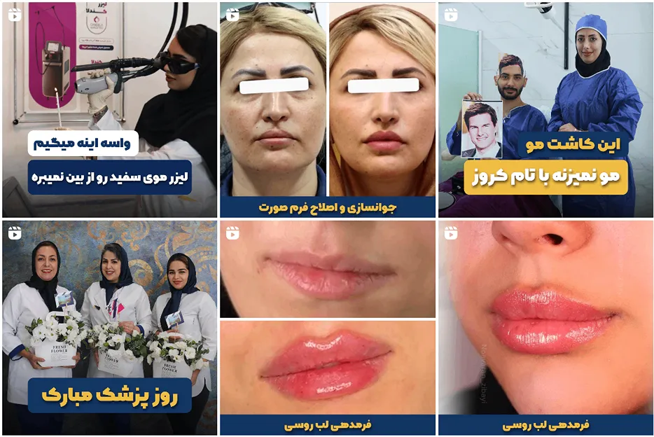 کاشت مو مشهد اقساطی در کلینیک نواوران زیبایی کاملا قابل انجام است