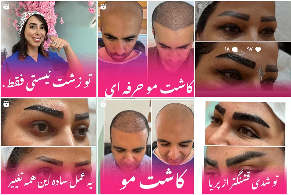 کاشت مو یاسوج توسط کلینیک تخصصصی کاشت مو پریجاد کاملا قابل انجام است