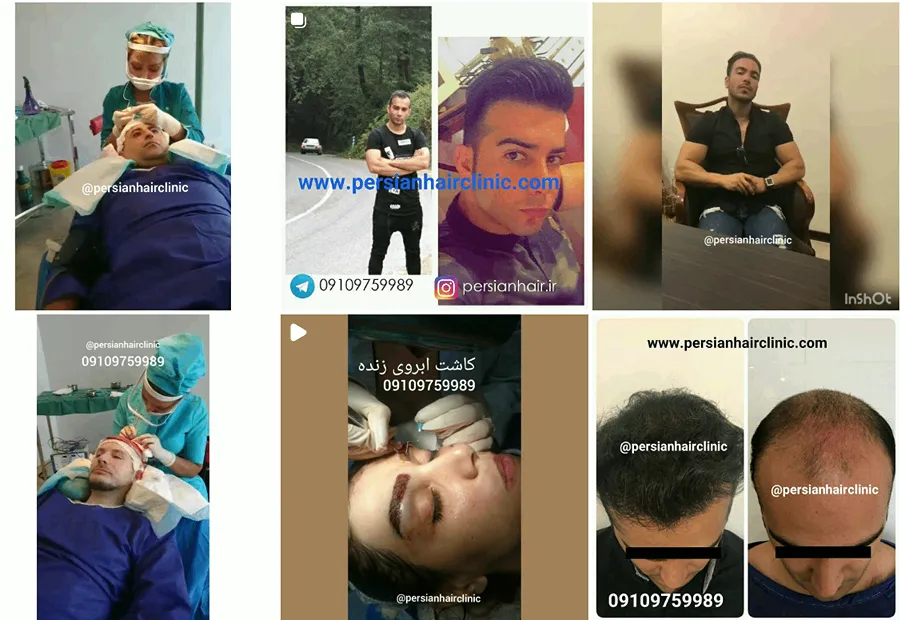 کلینیک پرشین هسر از بهترین کلینیک کاشت مو در تهران است
