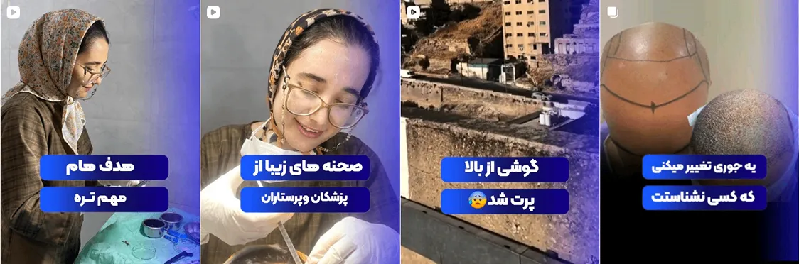 کاشت مو بوشهر توسط خانم قاسمی کاملا قابل انجام است