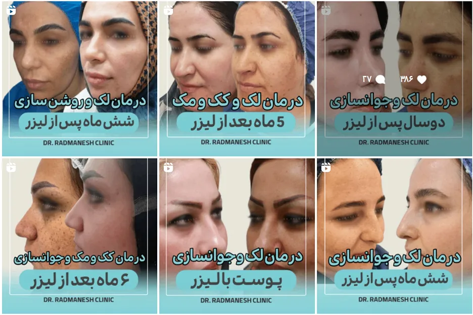 دکتر رادمنش از بهترین دکتر کاشت مو در اهواز است