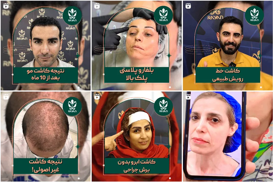 کاشت مو در تهران در کلینیک کاشت مو رایان کاملا قابل انجام است