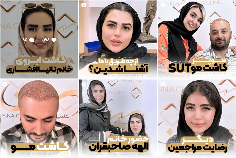 کلینیک رنسانس یکی از بهرتین کلینیک کاشت مو در تهران است