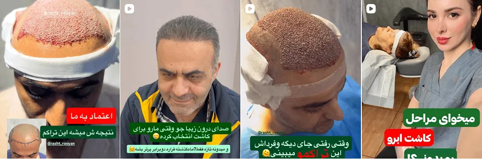 کاشت مو رشت در کلنیکی رویان کاملا قابل انجام است