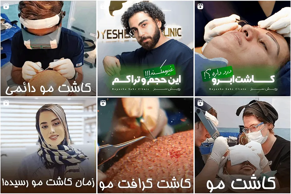 کلینیک رویش سلز از بهترین کلینیک کاشت مو در تهران است