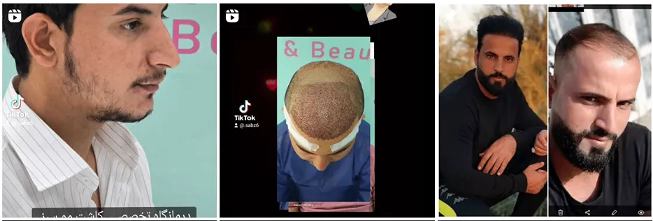 تصویر یکی از بهترین کلینیک کاشت مو در اهواز را مشاهده میفرمایید.