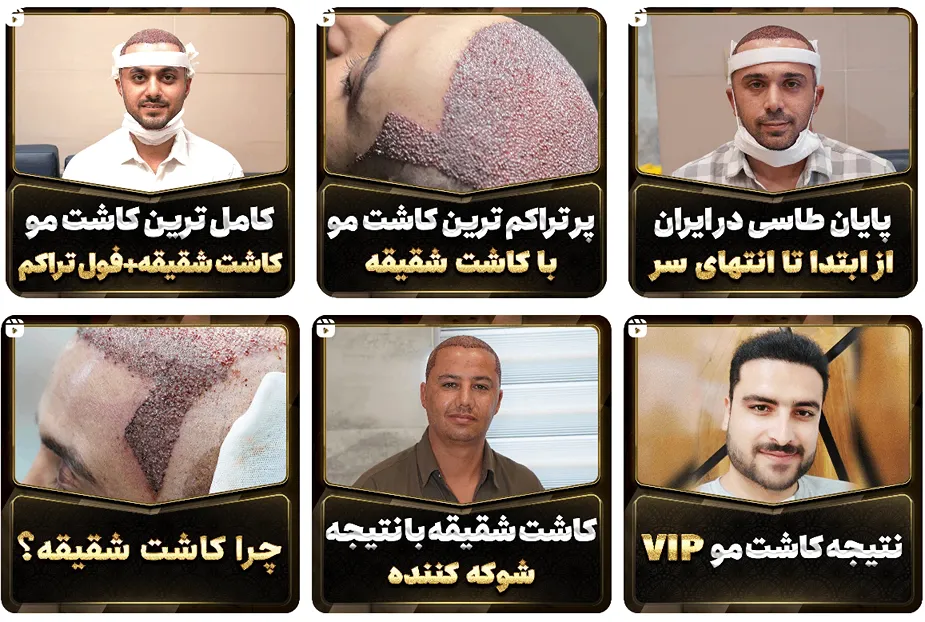 تصویر یکی از بهترین کلینیک کاشت مو در شیراز را مشاهده میفرمایید.