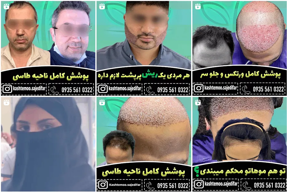 تصویر یکی از هبترنی کلینیک کاشت مو بیرجند را مشاهده مییفرمایید.