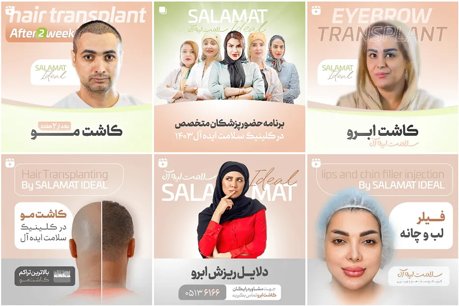 کاشت مو در مشهد در کلینیک سلامت ایده ال کاملا قابل انجام است