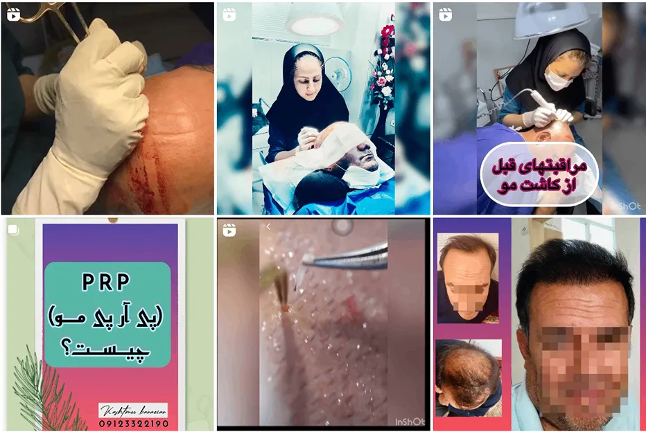 نمونه کار یکی از بهرتین دکتر کاشت مو در سمنان را مشاهده میفرمایید.