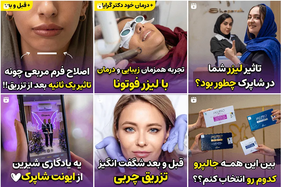 کاشت مو مشهد اقساطی در کلینیک پوست و مو شاپرک کاملا قابل انجام است