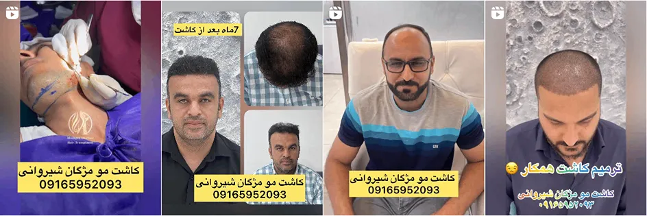 نمونه کار یکی از بهترین کلینیک کاشت مو اهواز را مشاهده میفرمایید.