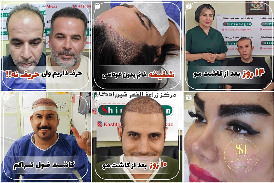 تصویر یکی از بهترین کلینیک کاشت مو در اهواز را مشاهده میفرمایید.