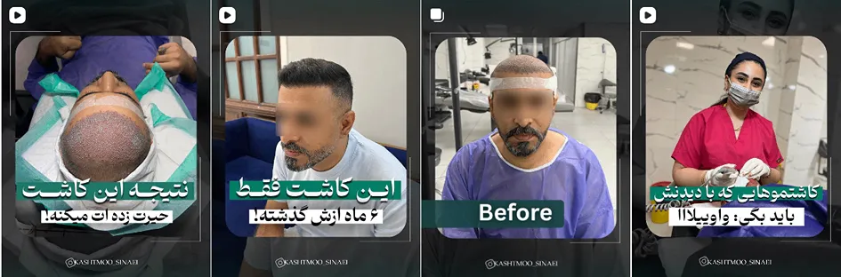 نمونه کار بهترین کلینیک کاشت مو بندرعباس را مشاهده میفرمایید.