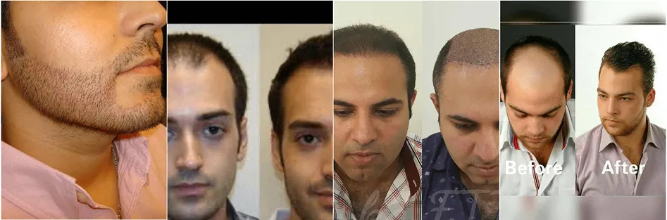 کاشت مو رشت توسط خانم سروری کاملا قابل انجام است