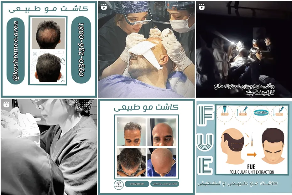 کاشت مو بجنورد توسط بهترین مراکز و کلینیک ها کاملا قابل انجام است