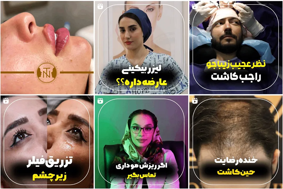 کاشت مو در تهران در کلینیک زیبایی تهران نوین کاملا قابل انجام است