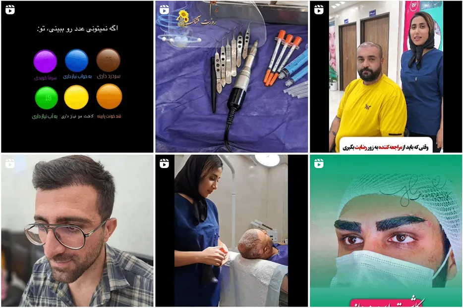 نمونه کار کاشت مو یاسوج خانم یوسفی را مشاهده میفرمایید.