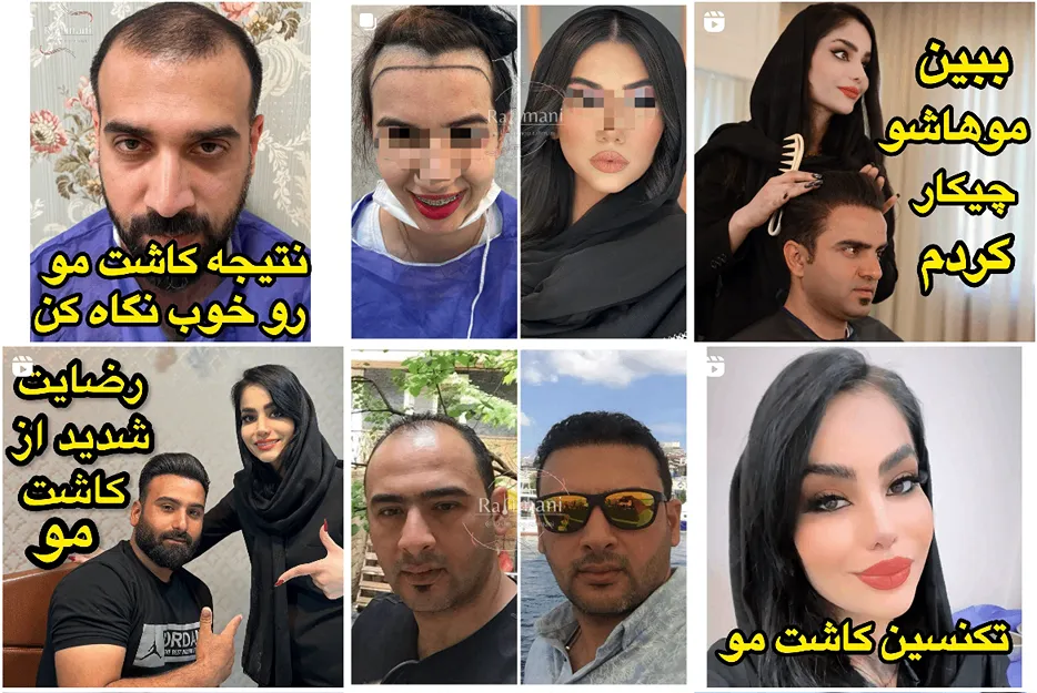 کاشت مو اقساطی مشهد توسط خانم رحمانی کاملا قابل اجرا است