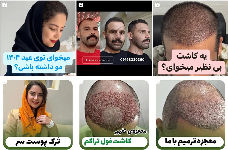 نمونه کار کی از بهترین دکتر کاشت مو اهواز را مشاهده میفرمایید.