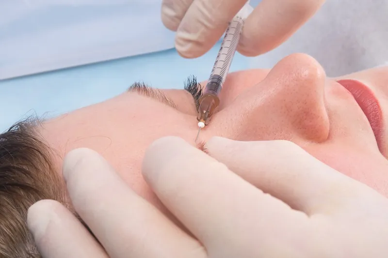 بسیاری از عوارض جانبی ابرو مزوتراپی ابرو کاملا مقطعی و کوتاه مدت است