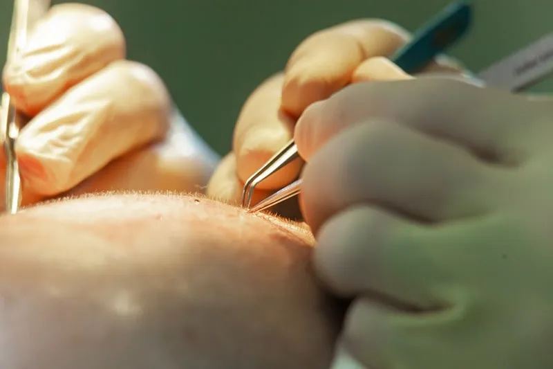 کاشت مو به روش FUT یکی دیگر از جدیدترین روش کاشت مو در مشهد است