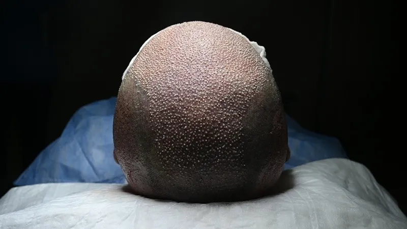 کاشت مو به روش تکثیر یکی از بروزترین و مدرن ترین روش های کاشت مو است.