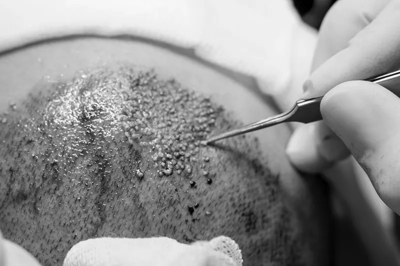 توجه به سن کاشت مو میتواند نتیجه این جراحی را بصورت مستقیم تحت تاثیر خود قرار دهد.