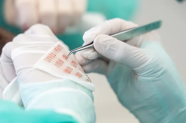 در کاشت مو به روش تکثیری از مراحل خاص و مهمی استفاده میشود.