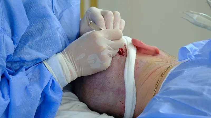 کاشت مو یکی از بهترین راه حل های دائمی در مقابل ریزش موهای سر است