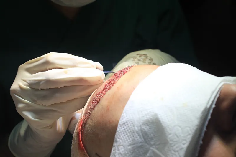 کاشت مو به روش سلولهای بنیادی یکی از بهترین و بروزترین روش های کاشت است