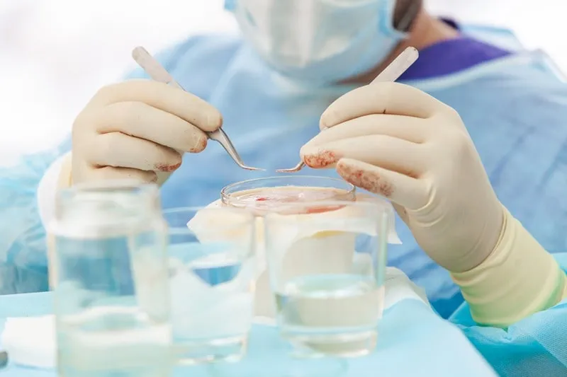 یکی از کم تهاجمی ترین و در عین حال بهترین روش های کاشت مو در مشهد روش سلولهای بنیادین است.