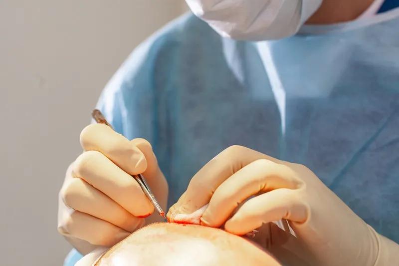 مراحل کاشت مو شامل اجزا مختلف و گوناگونی است