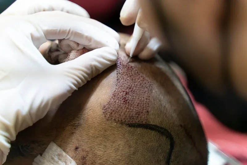 توجه به سن کاشت مو، ارتباط و تاثیر مستقیمی بر روند موفقیت بعد از کاشت دارد.