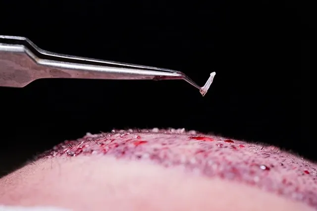 انتقال پیوندهادر روش تکثیر مو به سهولت قابل انجام است.