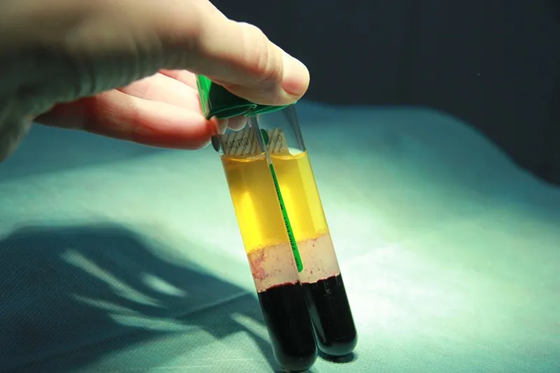 از جمله عوامل مهم در پی آر پی صورت نوع وکیفیت کیت بکار رفته در آن است