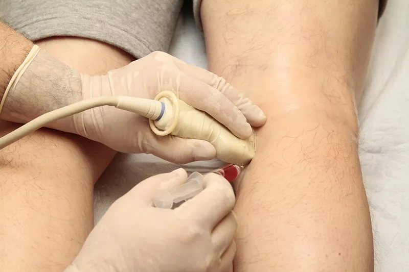 پی آر پی زانو یک روش درمانی بسیار عالی است