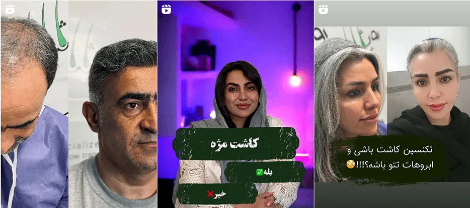 نمونه کار یکی از بهرتین دکتر کاشت ابرو در همدان را مشاهده میفرمایید.