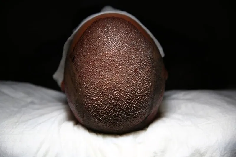 طریقه خوابیدن بعد ازکاشت مو در تقویت موهای کاشته شده نیز بسیار اثرگذار است.