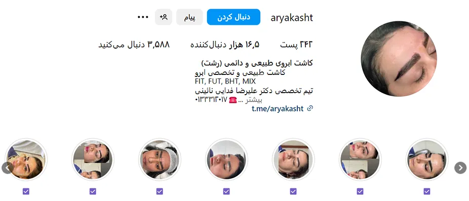 کاشت ابرو در رشت در کلینیک زیبایی آریا کاملا قابل انجام و در دسترس است