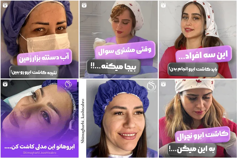 نمونه کار دکتر خوب کاشت ابرو در مشهد را مشاهده میفرمایید.