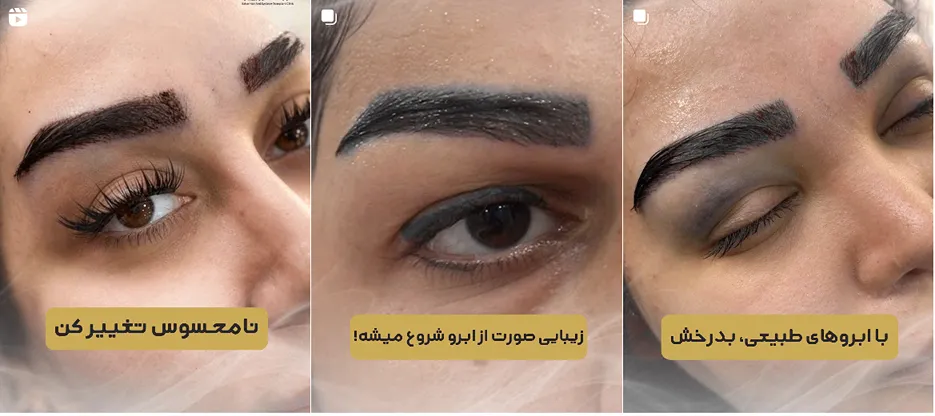 کاشت ابرو در گرگان در کلینیک زیبایی بهار کاملا قابل انجام است