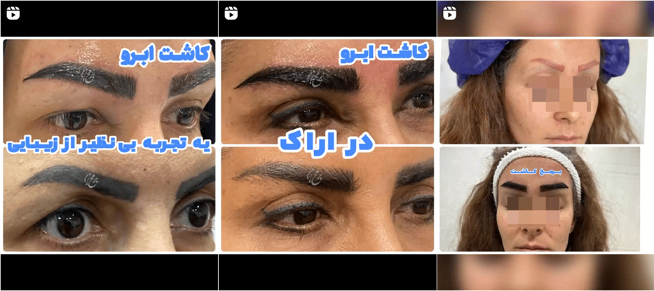 نمونه کار یکی دیگر از بهترین مراکز کاشت ابرو اراک را مشاهده میفرمایید.