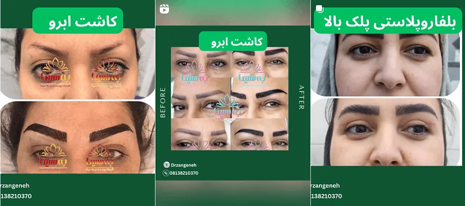 نمونه کار یکی از بهترین کلینیک کاشت ابرو همدان را مشاهده میفرمایید.